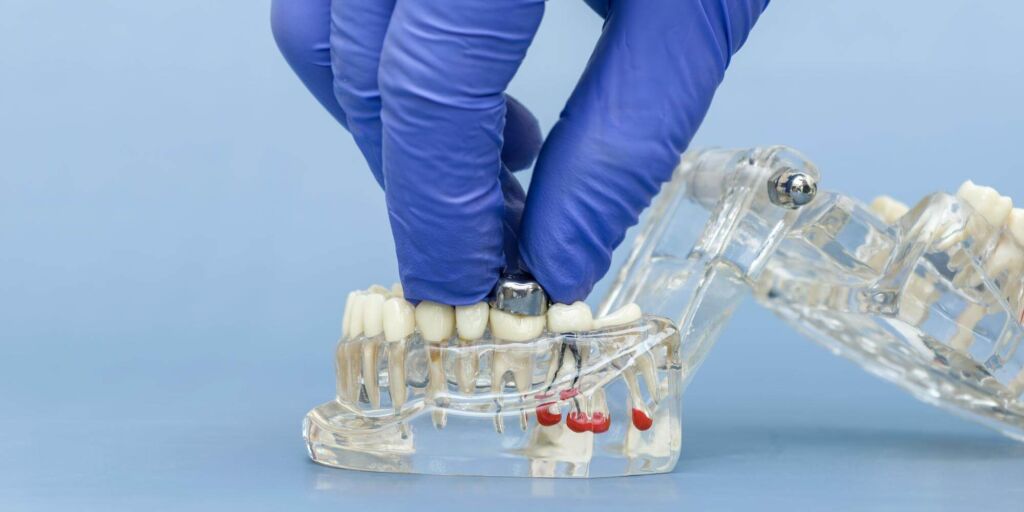 implantatwechsel (kapselfibrose, implantatalter)