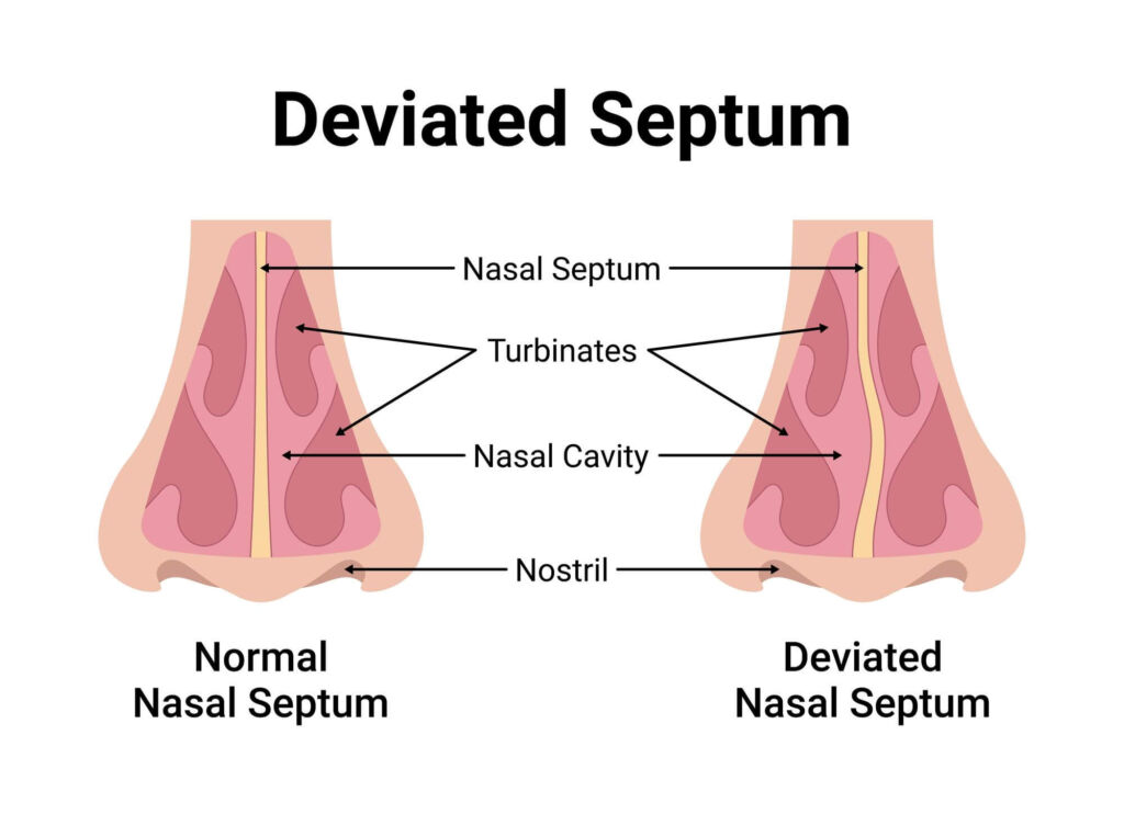 verkrümmte nasenscheidewand (septumdeviation)